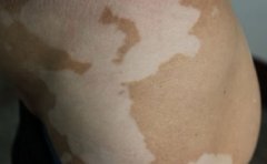 喝茶对白癜风有好处吗