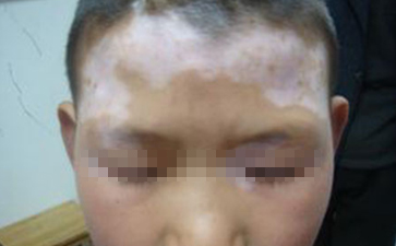 白癜风是怎么引起的