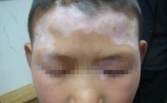 脸上出现白癜风有哪些护理方法