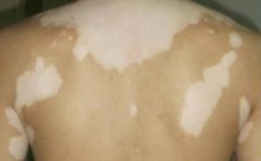 身上有白癜风要怎么治?