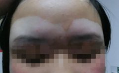 秋冬季还需要治疗白癜风