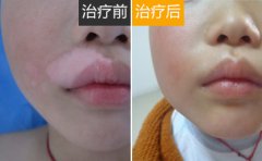 脸部白癜风应该如何进行护理